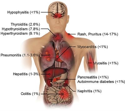 Organ-Specific Immune-Related Adverse Events for PD-1 Antibodies in Lung Cancer Treatment